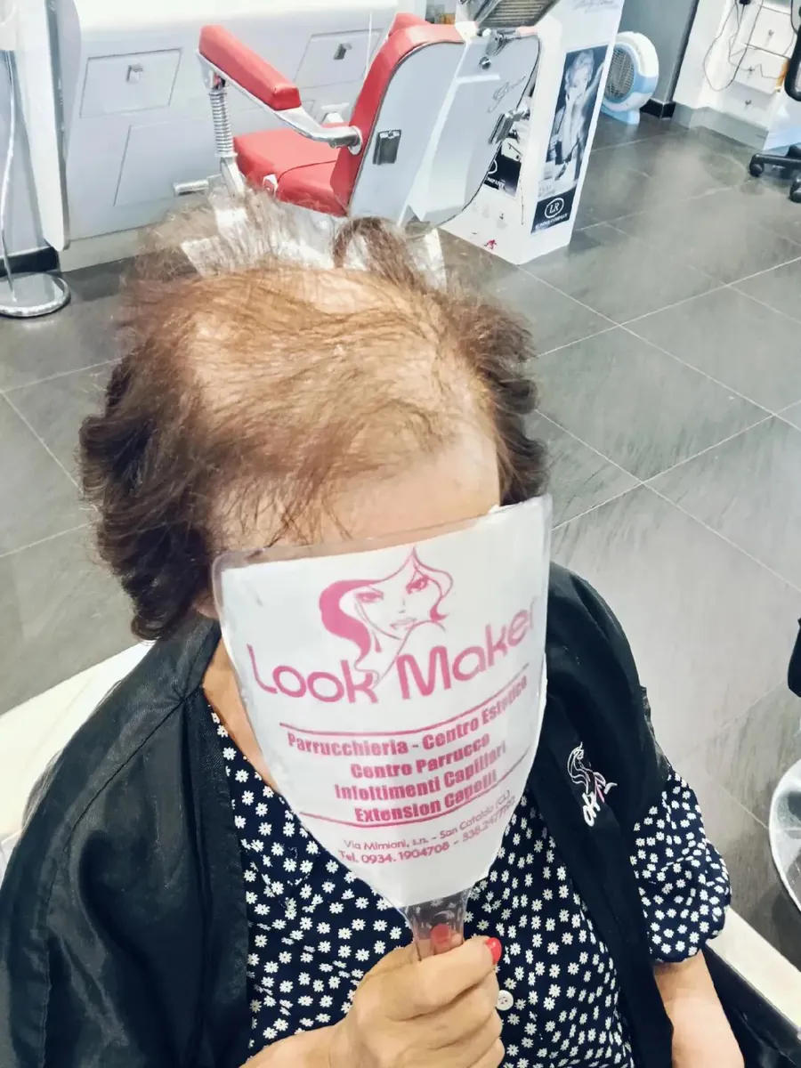 Prima: capelli radi sulla sommità