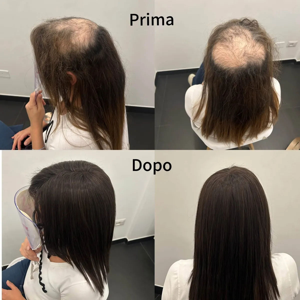 Prima e dopo: dalla sommità rada ai capelli castani lunghi